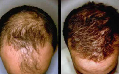 PRP for the Hair and Scalp