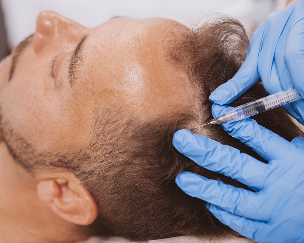 PRP London Hair Loss Treatment