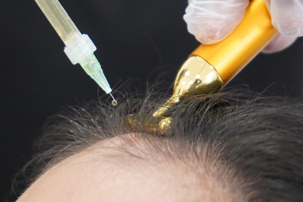 Covid 19 Hair Loss - PRP