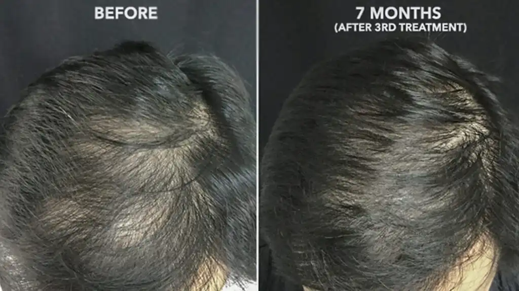 PRP Before and After Results