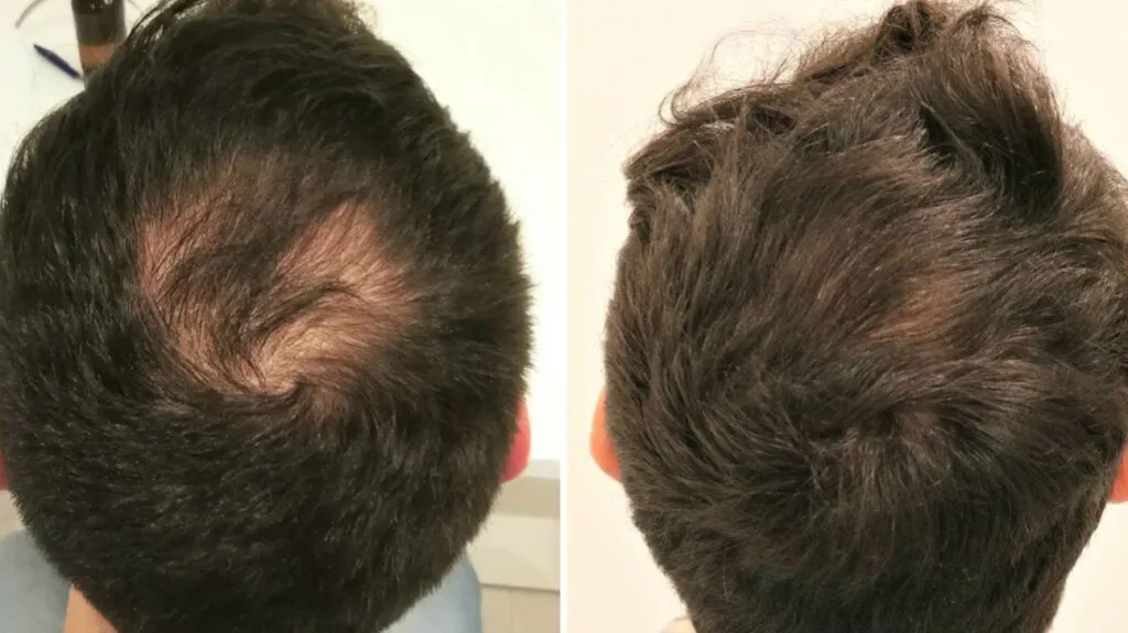 PRP hair loss Before and After