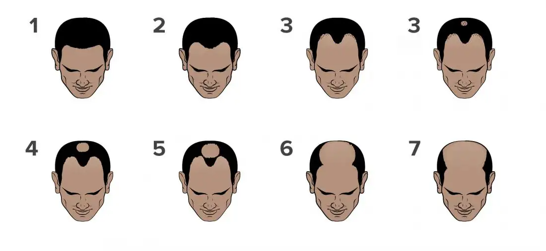 Norwood Scale for hair loss