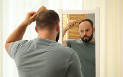 Male Pattern Baldness: Stages, Causes and Treatments