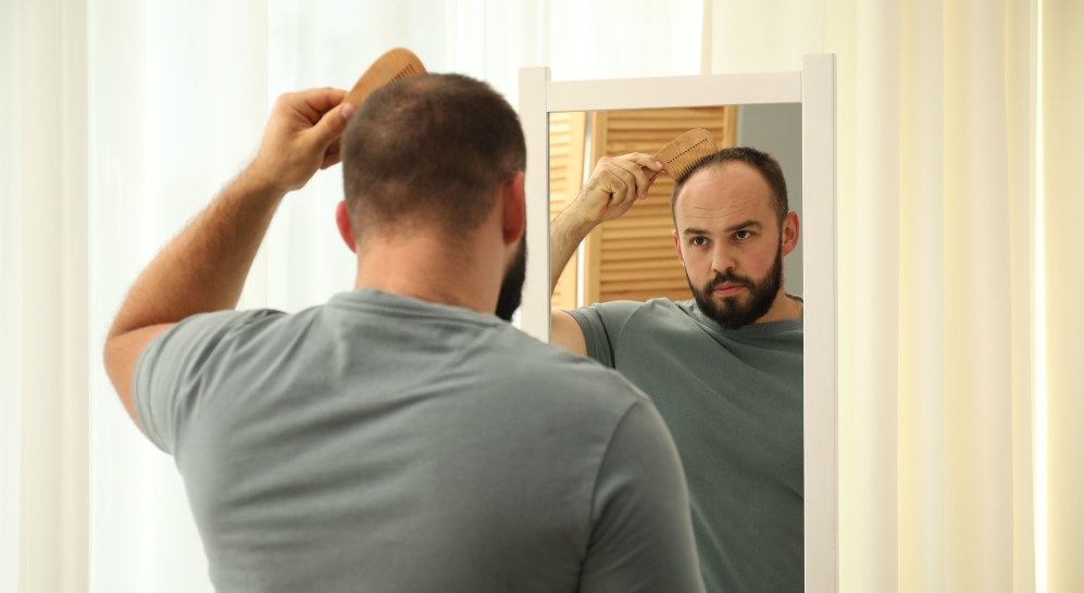 Male Pattern Baldness: Stages, Causes and Treatments
